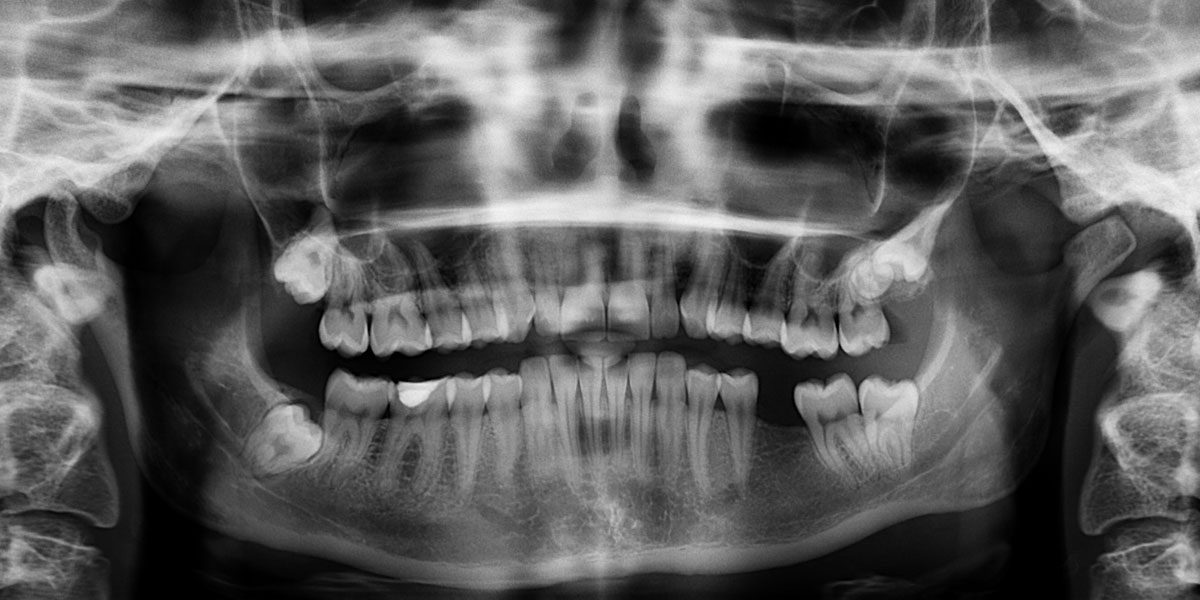Dental X-rays are dangerous